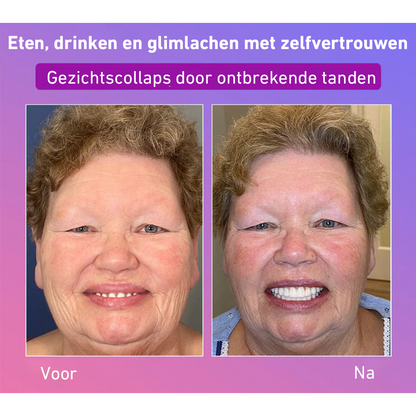 🦷Hermsa® Comfortabele kunstgebittenvan de volgende generatie🏆 (hoogwaardige kunstgebitten, gemakkelijk te dragen - beperkte korting van 70%)