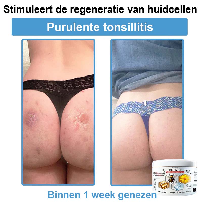 Raindew™ Bijengif Multisymptoom Behandelingscrème (👨‍⚕ Aanbevolen door de Nederlandse Vereniging voor Dermatologie)
