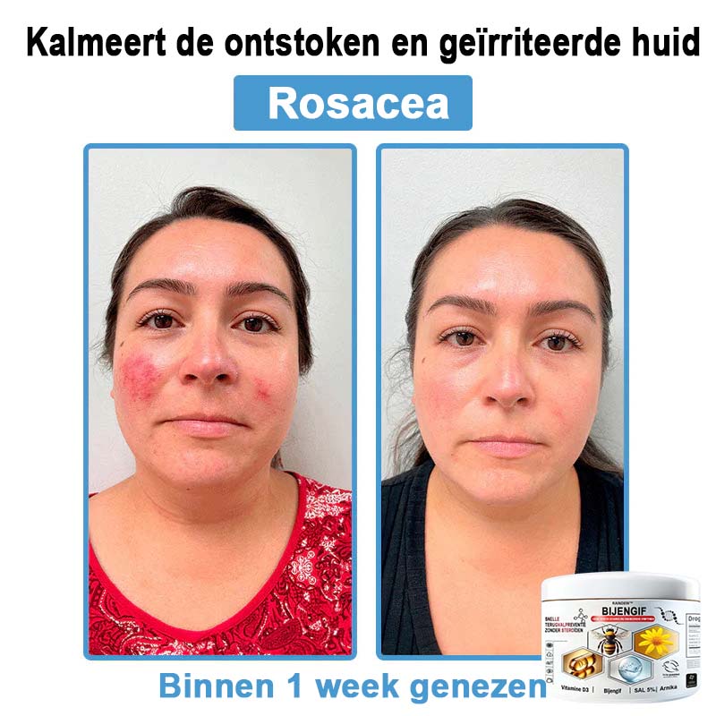 Raindew™ Bijengif Multisymptoom Behandelingscrème (👨‍⚕ Aanbevolen door de Nederlandse Vereniging voor Dermatologie)