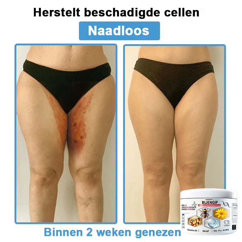 Raindew™ Bijengif Multisymptoom Behandelingscrème (👨‍⚕ Aanbevolen door de Nederlandse Vereniging voor Dermatologie)