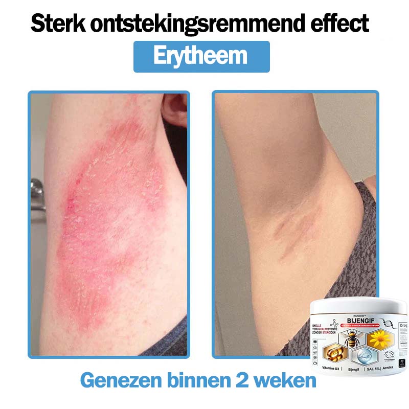 Raindew™ Bijengif Multisymptoom Behandelingscrème (👨‍⚕ Aanbevolen door de Nederlandse Vereniging voor Dermatologie)