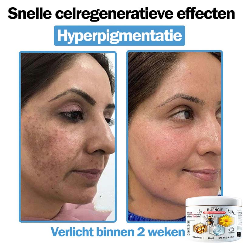 Raindew™ Bijengif Multisymptoom Behandelingscrème (👨‍⚕ Aanbevolen door de Nederlandse Vereniging voor Dermatologie)